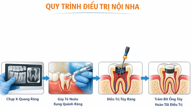 Quy trình điều trị nội nha