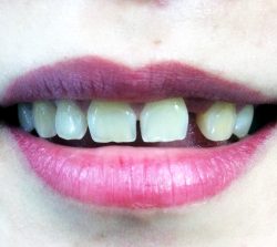 Patient 4_before